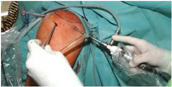 Térdizületi tükrözés